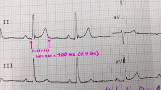 The Qt interval [upl. by Gaylord]