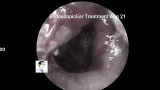 Treatment of recurrent external auditory canal cholesteatoma with otoendoscopy for 13 minutes [upl. by Mohr]