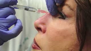 Nonsurgical Rhinoplasty [upl. by Akcinehs]