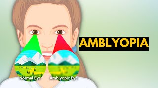 Amblyopia Causes Signs and Symptoms Diagnosis and Treatment [upl. by Nivets138]