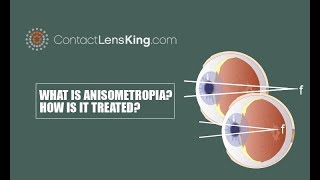 What is Anisometropia How is Anisometropia Treated [upl. by Nottage993]