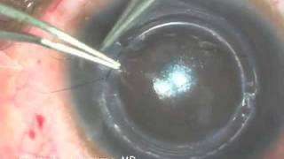 Intacs Insertion for Keratoconus [upl. by Gnivre]