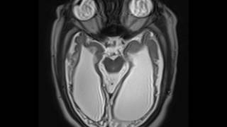 Periventricular Leukomalacia [upl. by Rehoptsirhc]