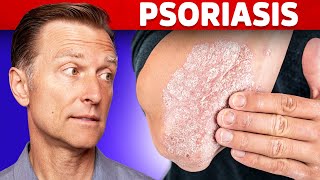 Psoriasis Treatment – The Best 3 Remedies for Psoriasis – DrBerg [upl. by Campy]