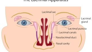 Nasolacrimal Duct Obstruction [upl. by Annayr]