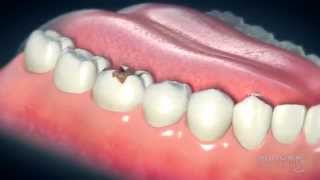 Dental Crowns Everything You Need to Know [upl. by Sell]