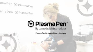 Plasma Pen Before and After  Fibroblast Before and After Treatment  Plasma Pen [upl. by Mirak]