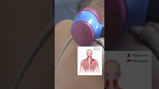 How Do You Release Trapezius Pain [upl. by Gnilhsa]