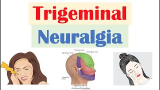 Trigeminal Neuralgia “Severe Facial Pain” Causes Pathophysiology Symptoms Diagnosis Treatment [upl. by Allerym]