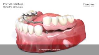 Partial denture  SlimLineSE [upl. by Atinuaj]