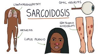 Idiopathic Granulomatous Orchitis  Pathology mini tutorial [upl. by Lennad742]