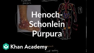 HenochSchonlein purpura  Circulatory System and Disease  NCLEXRN  Khan Academy [upl. by Nilesoy]