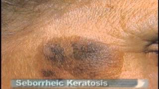 Common Skin Lesions [upl. by Donni]