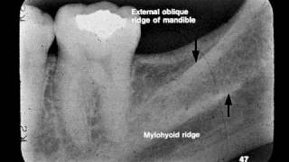 Dental Radiographic Anatomy [upl. by Pryce]