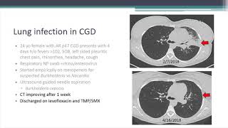 Lung InflammationGranuloma Problems with CGD [upl. by Akerehs]