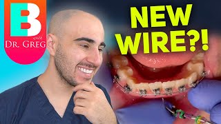 Braces Wire Tightening  Why amp How Your Orthodontist Changes Your Braces Wires [upl. by Ynnor]