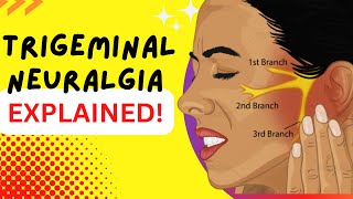 Trigeminal Neuralgia  Explained  Worlds most painful disease Causes and Treatment [upl. by Skrap]