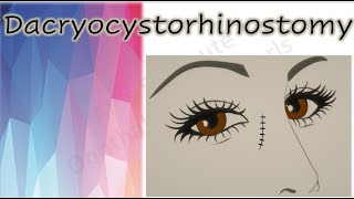 Dacryocystorhinostomy  DCR [upl. by Elurd350]