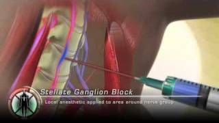 Stellate Ganglion Block Injection [upl. by Farlee]