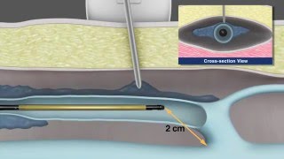 Patient instruction for venous ablation [upl. by Eecyac]