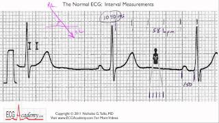 Interval Measurements 64  ECG  EKG Interpretation  BASIC [upl. by Rockie]