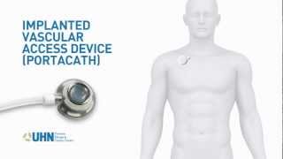 PortaCath Implanted Vascular Access Device [upl. by Ynohtna]