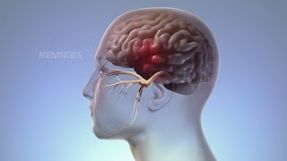 How to Stop Having a Vestibular Migraine In 4 minutes [upl. by Aramoy198]