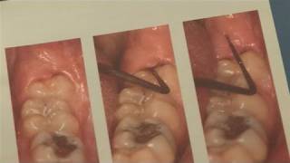 How To Alleviate Infected Wisdom Tooth [upl. by Bick]