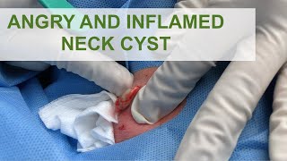 Angry Inflamed Neck Cyst  Dr Derm [upl. by Burnsed]