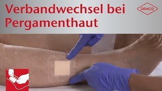 Schmerzfreier Verbandwechsel bei Pergamenthaut  Wundauflagen mit SilikonHaftrand [upl. by Jacobah]