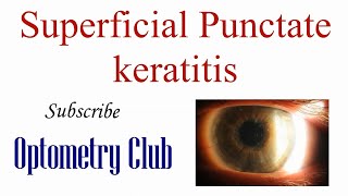 Superficial Punctate Keratitis Introduction Diagnosis and Treatment [upl. by Myrtice]